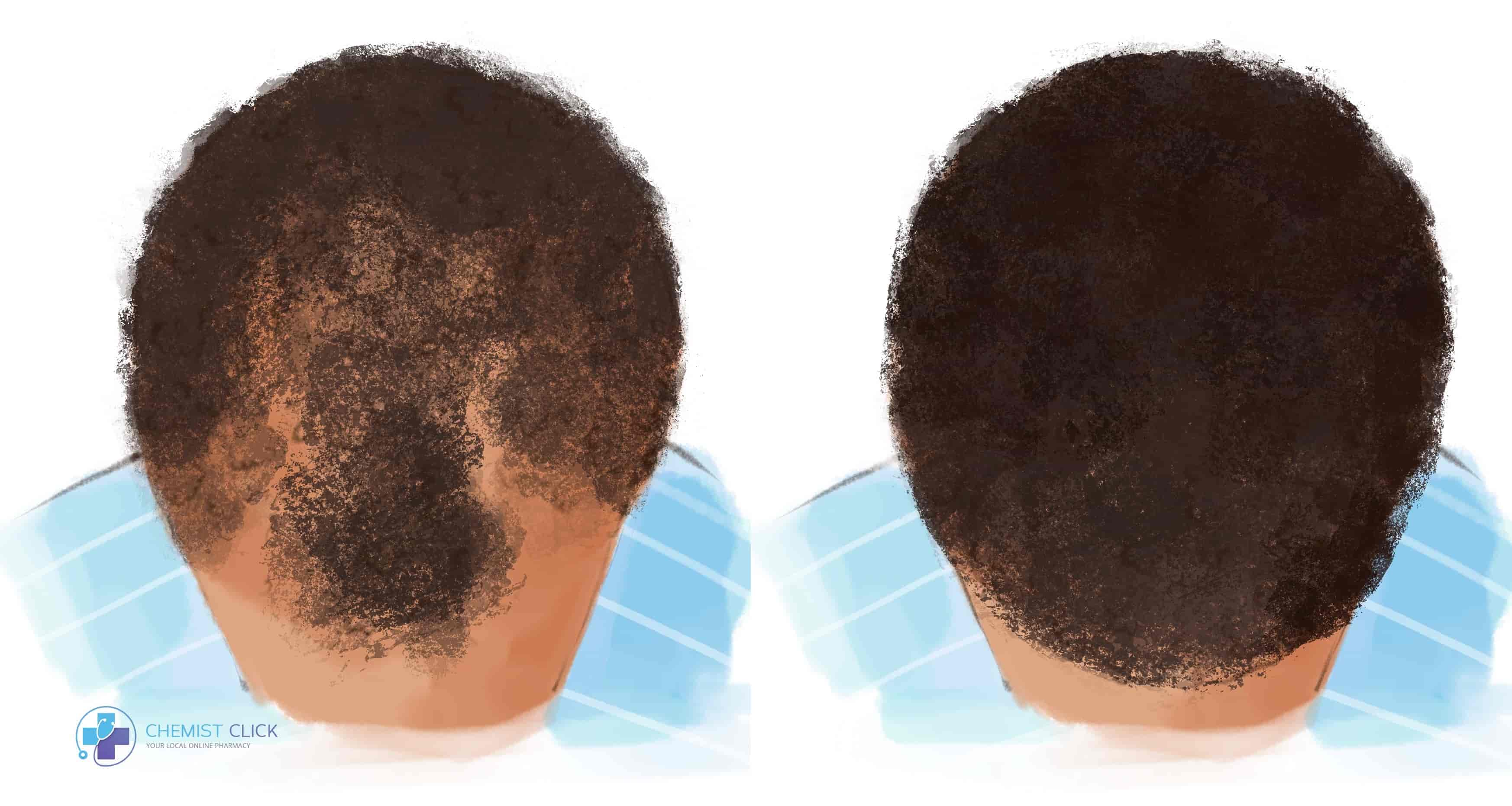 taking finasteride and minoxidil together