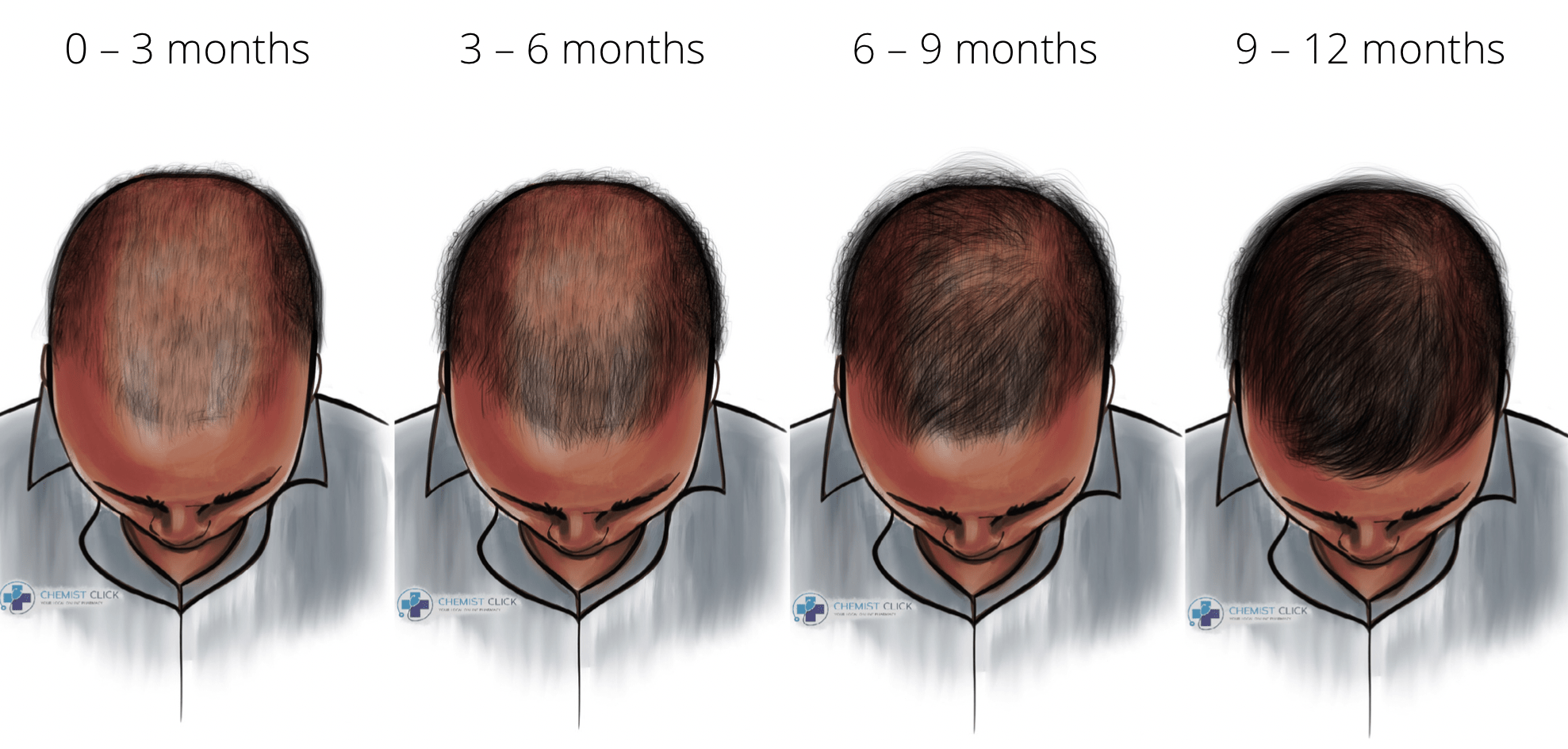 Finasteride Results Timeline With Pictures