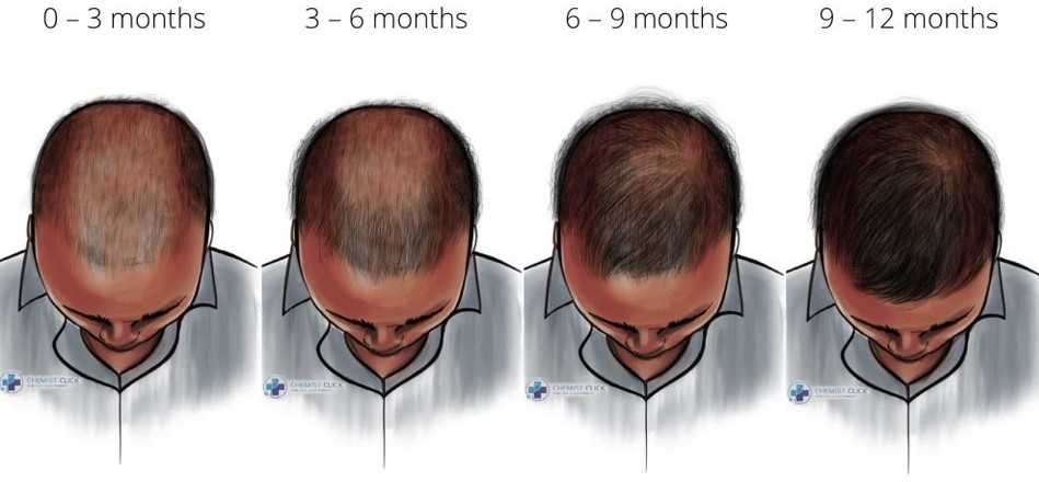 Best Finasteride For Hair Loss in Islamabad  Pakistan  Price  Cost