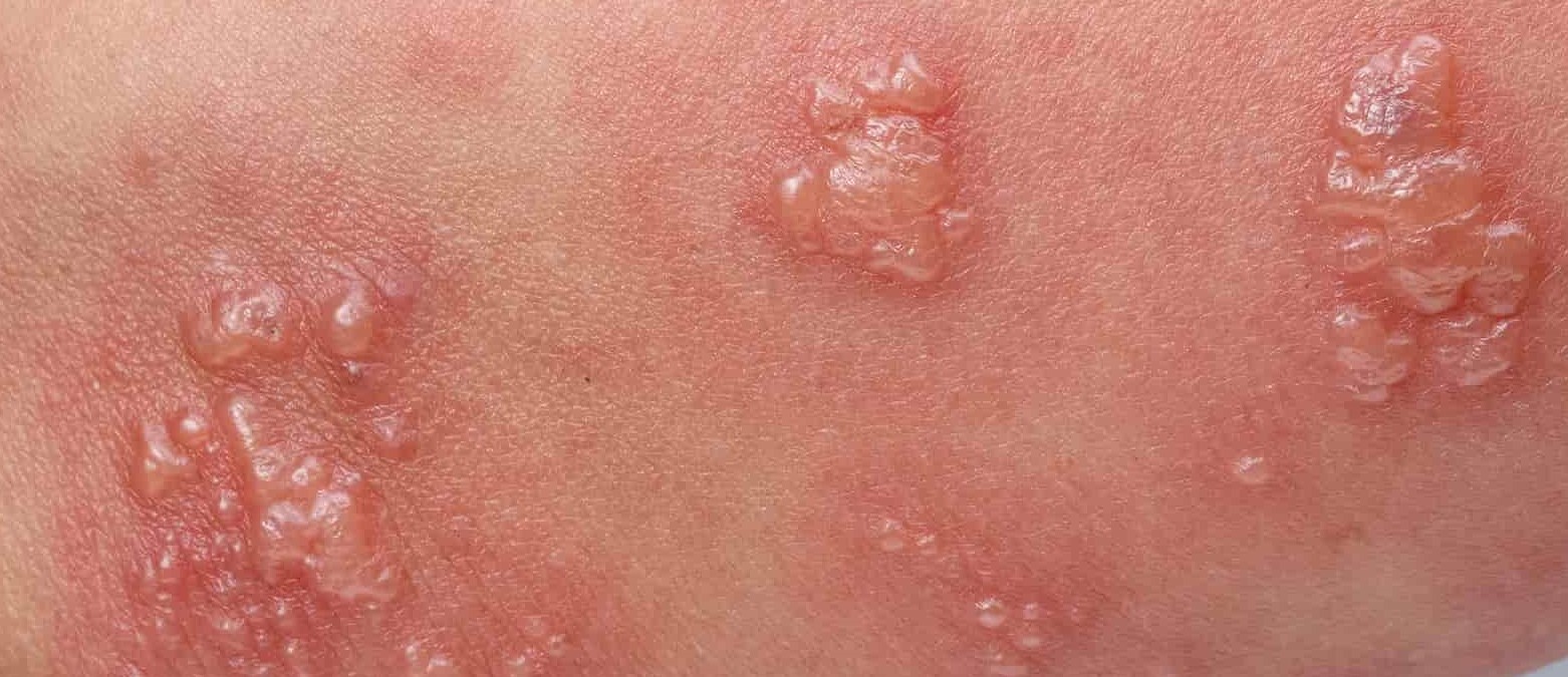 herpes or pimple