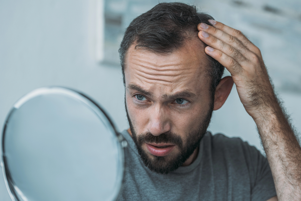 Man with Hair Loss Looking in a Mirror