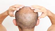 Male with Hair Loss