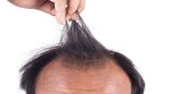 Receding Hairline