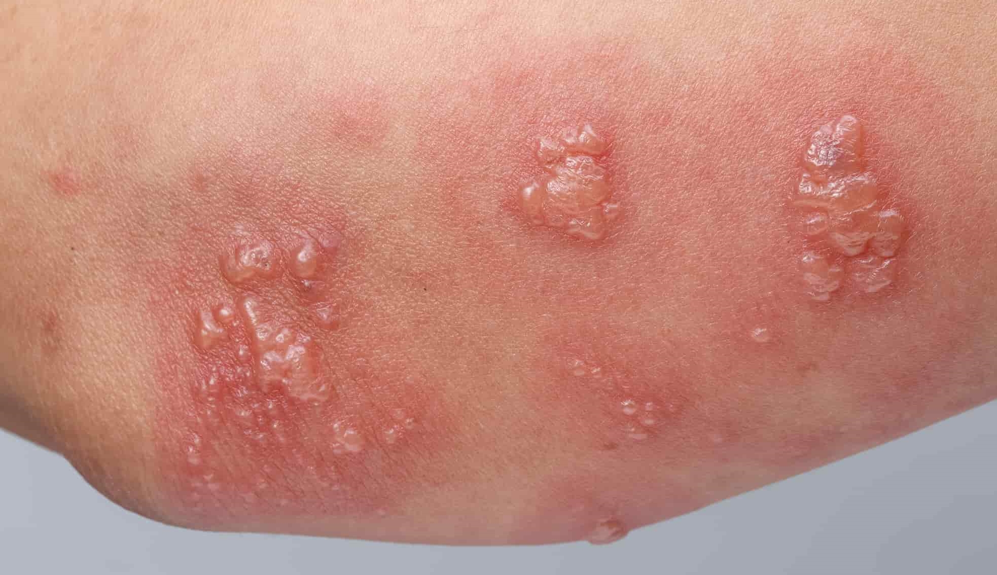 What Does A Herpes Rash Look Like? (With Pictures)