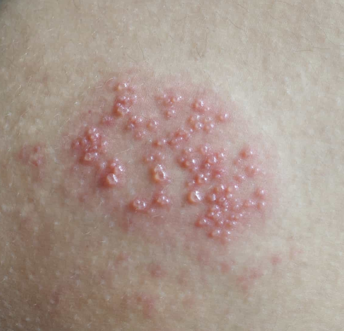 Genital Herpes on Thigh: Symptoms, Diagnosis, Treatment